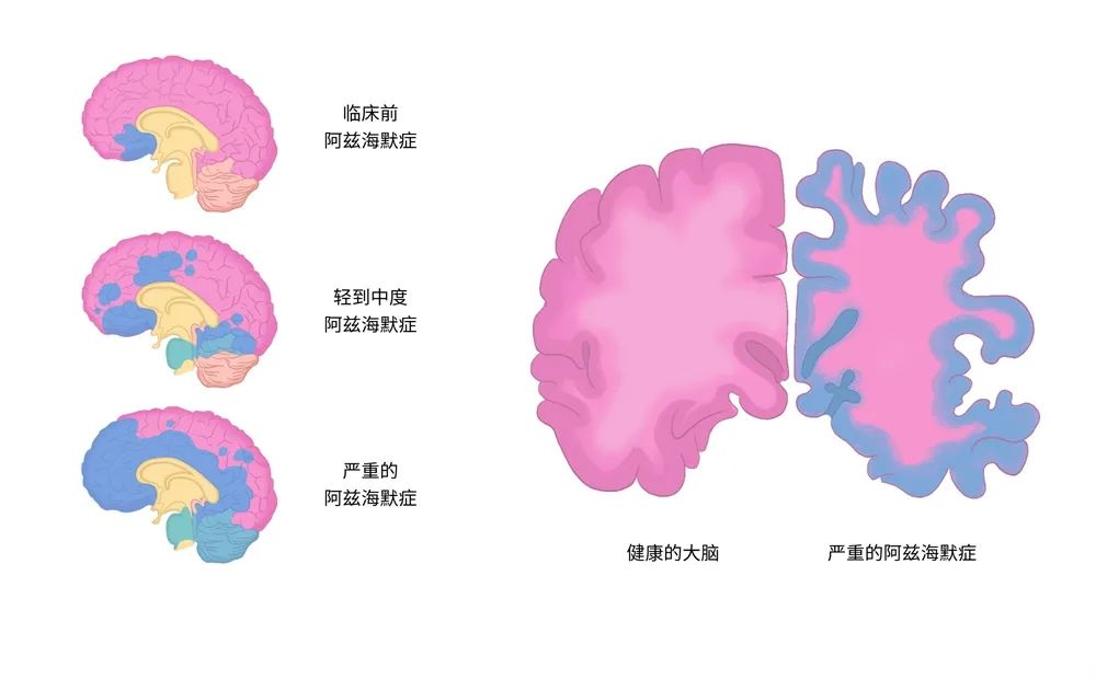 研究显示每天两次刷牙会降低患阿尔茨海默病性痴呆的可能