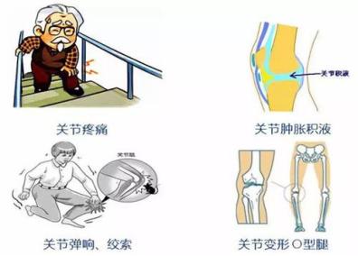 膝盖关节详图_膝盖关节图解大全_膝盖各个部位疼痛图解膝关节