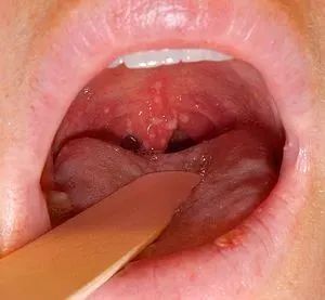 小孩喉咙长疱疹图片图片
