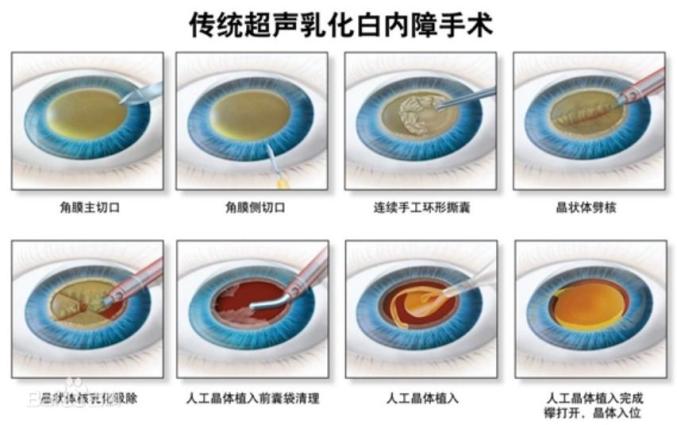 科普白内障手术是不是越晚做越好呢