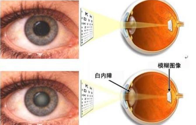 如何判断是白内障图片图片