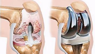 关节置换术后感染不要慌，找对专家很重要