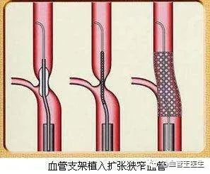 做完心脏支架能运动吗