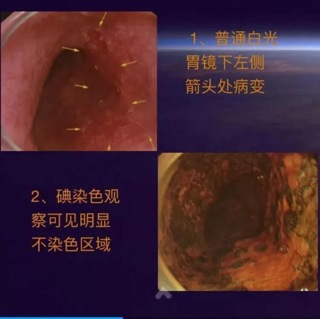 碘染色技術讓早期食管癌無處可藏