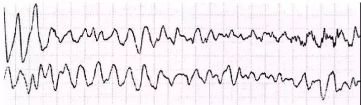 室颤的心电图