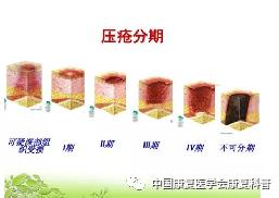 防压疮垫叫什么压疮——一个不可忽视的康复隐患_https://www.jmylbn.com_新闻资讯_第7张