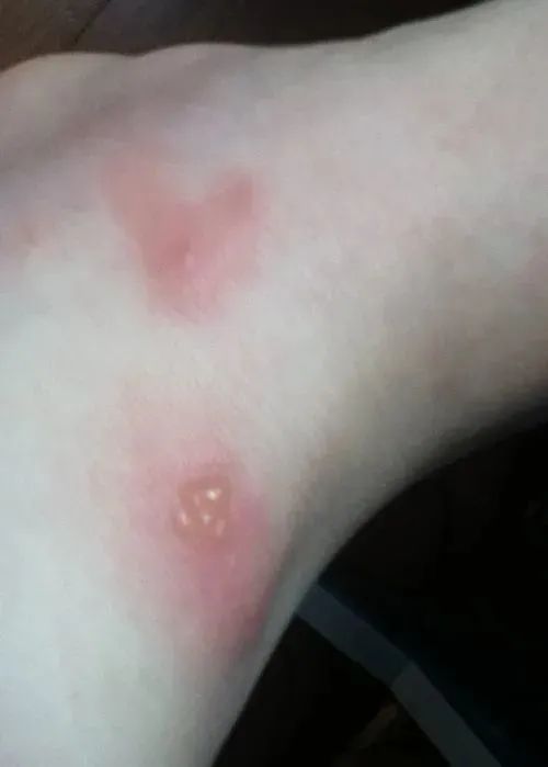 惊悚小蚂蚁咬一口差点要了命夏季来临要当心