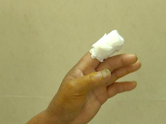 洗了只小龙虾,他差点截肢