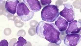 2型先天淋巴细胞，助力消灭黑色素瘤