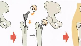 股骨頭壞死防治的幾大誤區，小心別入坑