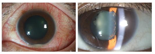 其实,这个病叫"虹膜睫状体炎",简称"虹膜炎"或者"虹睫炎".