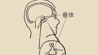 变丑、变胖、内分泌失调……有这些症状警惕脑肿瘤