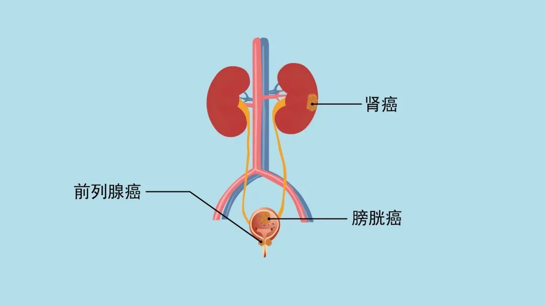 中老年男性常见泌尿系统疾病如何防治