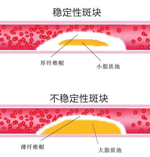 好好的血管怎么就堵了?可能是它在作怪