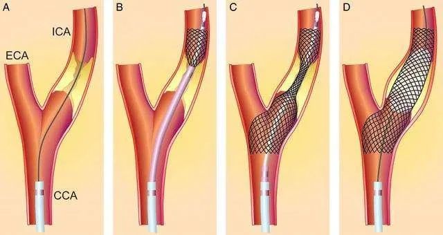 颈动脉狭窄谁适合接受支架治疗