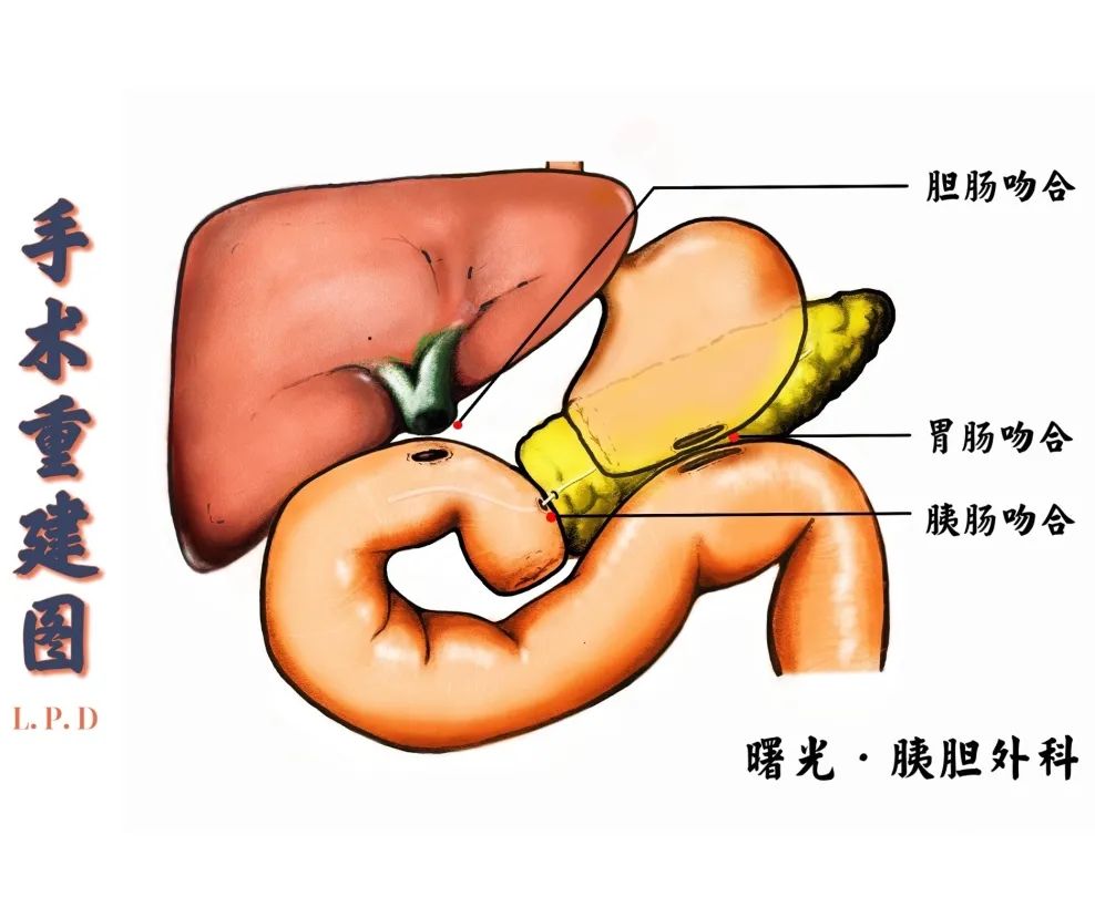 【曙光·动态】胰胆外科成功实施我院首例全腹腔镜胰十二指肠切除术