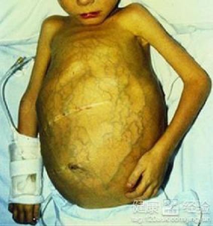 腹水可能突然发生,也可能逐渐发生,许多患者由于腹围增大才发现腹水.