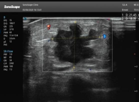 乳腺机为什么叫钼靶【小南话科普】乳腺检查，选超声还是钼靶？_https://www.jmylbn.com_新闻资讯_第2张