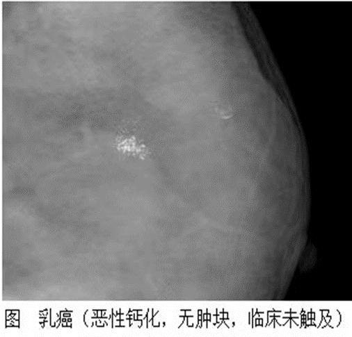 乳腺机为什么叫钼靶【小南话科普】乳腺检查，选超声还是钼靶？_https://www.jmylbn.com_新闻资讯_第6张