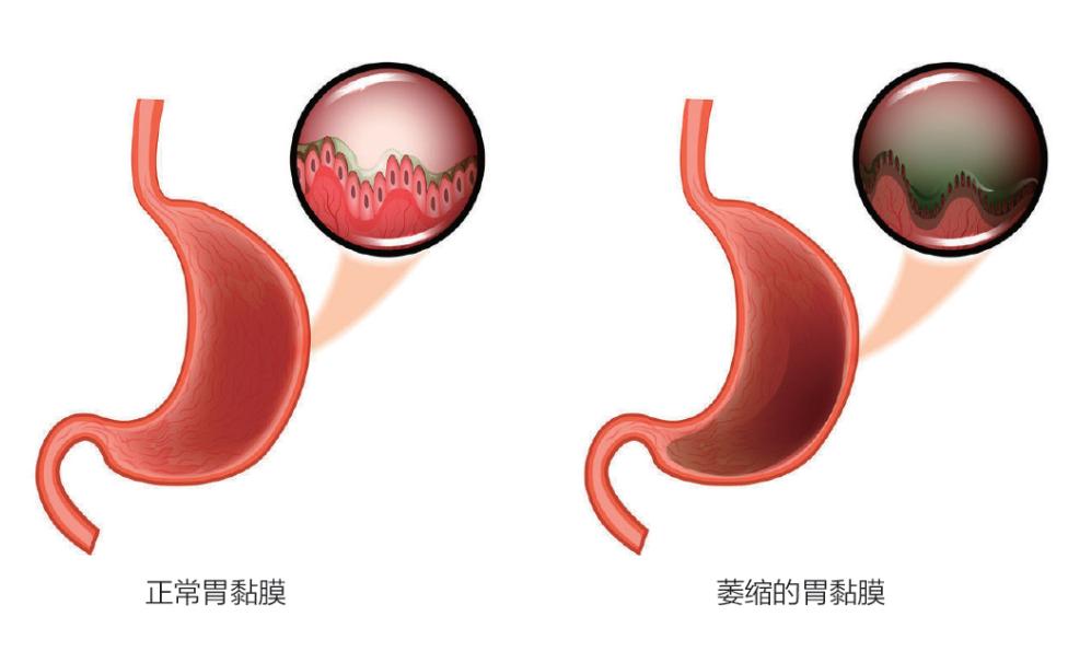 胃因何而萎缩