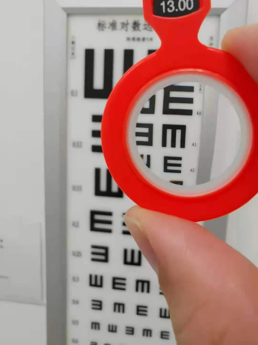 1300度近视行后巩膜加固联合上斜肌麻痹矫正术