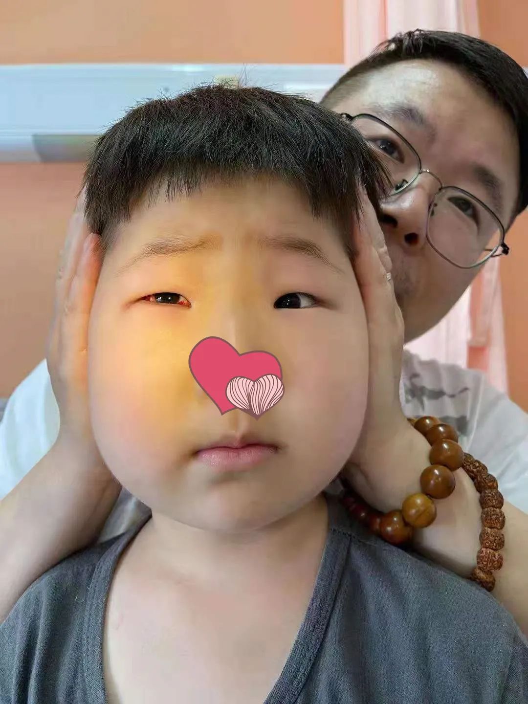 1300度近视行后巩膜加固联合上斜肌麻痹矫正术