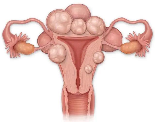 良性疾病,如子宫肌瘤,子宫腺肌症或腺肌瘤,绝经后子宫内膜复杂增生