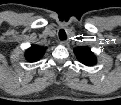 气管异物ct图片
