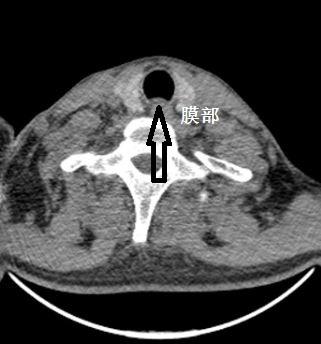 气管里一大个肿物,普通ct平扫为什么漏诊?