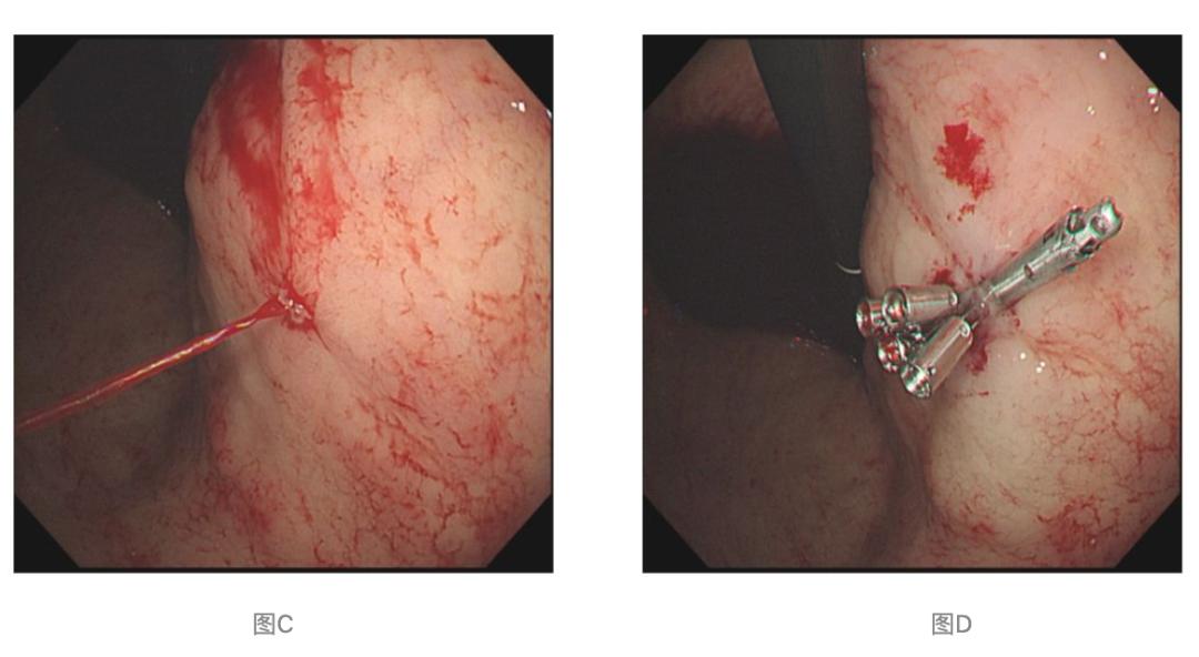 纠正失血性休克的同时,完善急诊胃镜提示:胃体中段小弯侧黏膜有一裸露