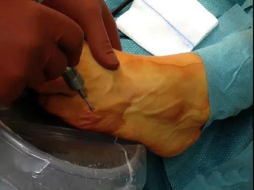 小脚趾难看可能是得了裁缝趾