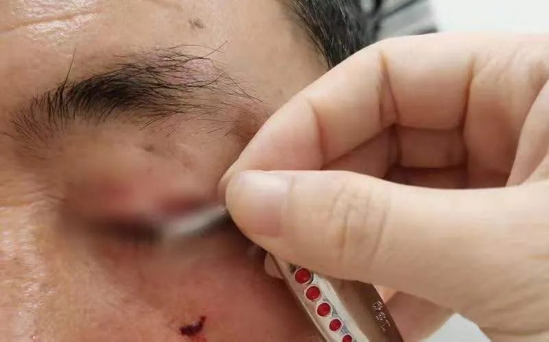 惊险!三叉形状鱼钩钩住眼睑,金山医生妙手取出