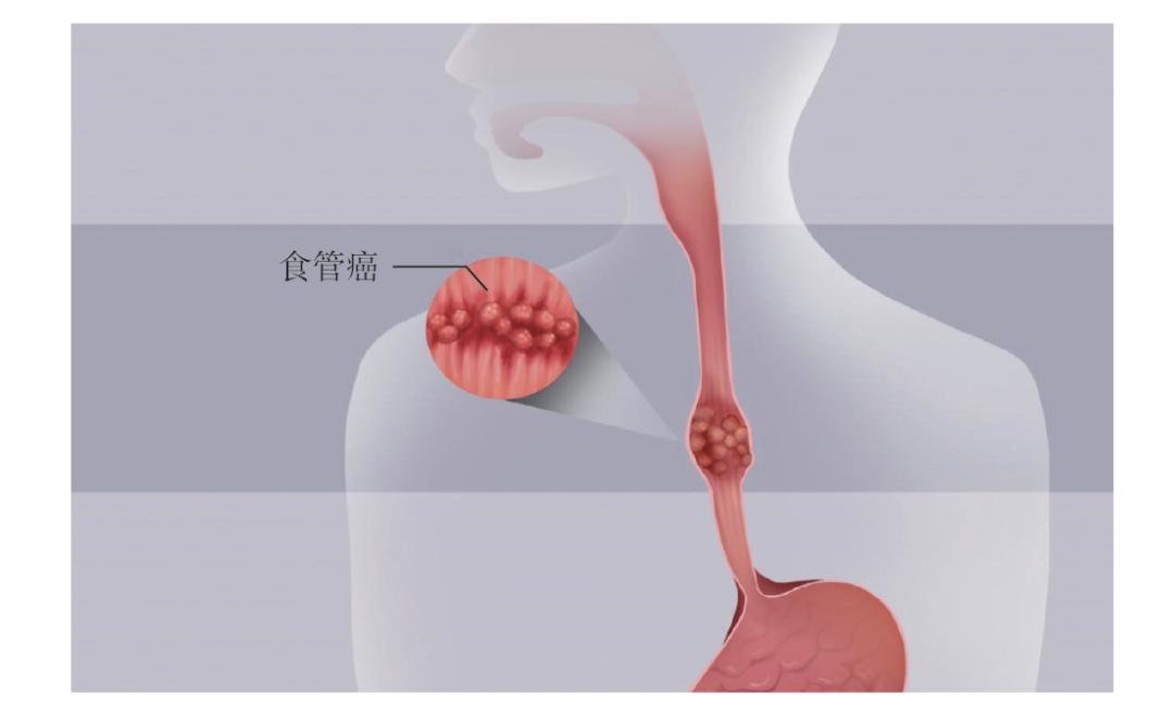 出现前胸或后背隐痛 别忽视了食管的问题