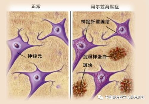 睡眠不好可诱发阿尔茨海默病?