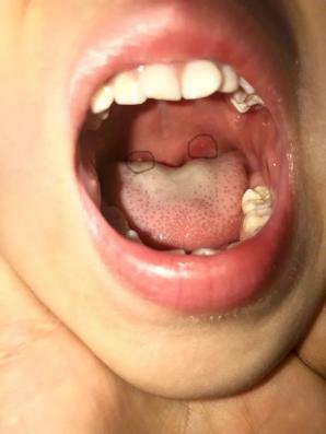 孩子喉咙发白图片图片