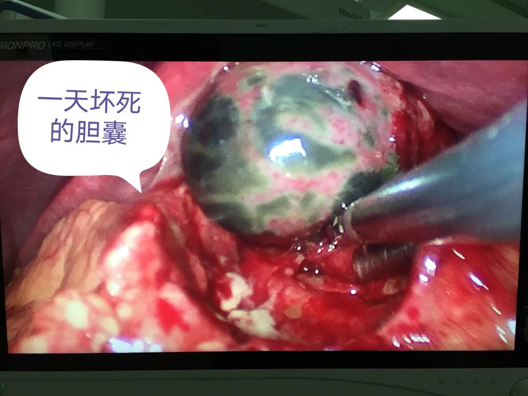 【病案现场】警惕急性进展迅速的坏疽性胆囊炎