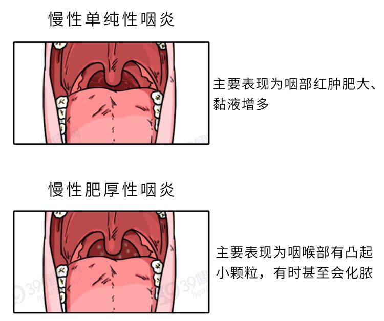 慢性单纯性咽炎和慢性肥厚性咽炎两种病理上可分为咽喉部及淋巴组织