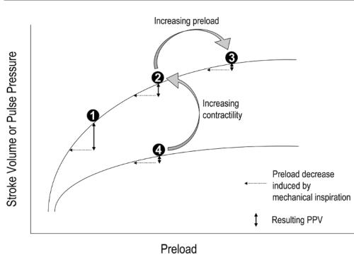 正压通气中,脉压随呼吸的变化性(ppv)指明了患者在frank-starling曲线
