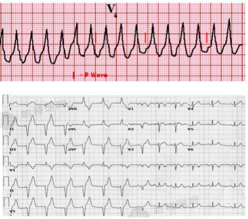 室性自主心律心电图图片