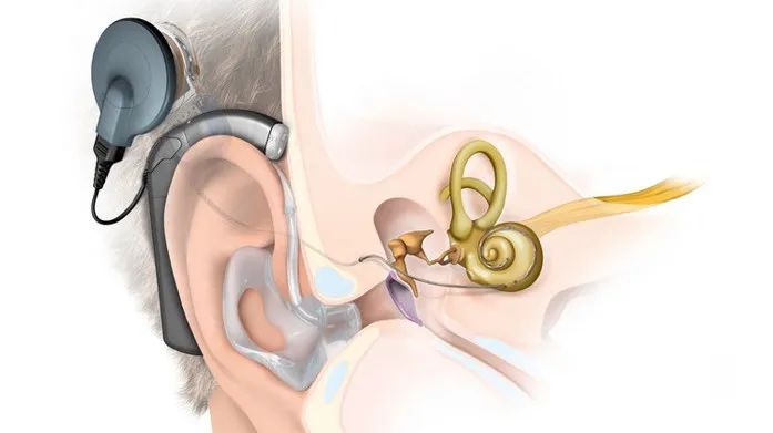 华东新闻我院首例人工耳蜗手术解决鼻咽癌引发复杂听力问题