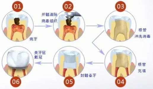 為什麼根管治療後醫生總是勸我們要做冠