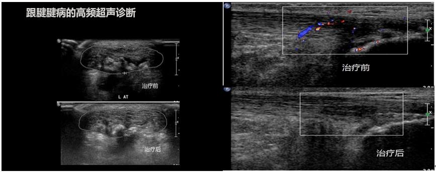 腱病治疗后超声评估跟腱断裂跟腱损伤,无论皮肤有没有破损,都建议及时