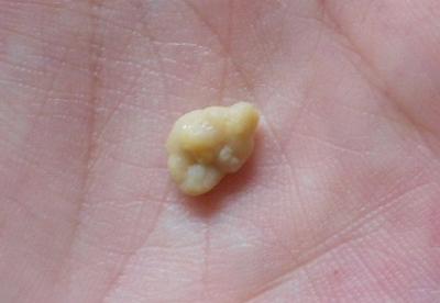 新生儿喉咙长白色颗粒图片