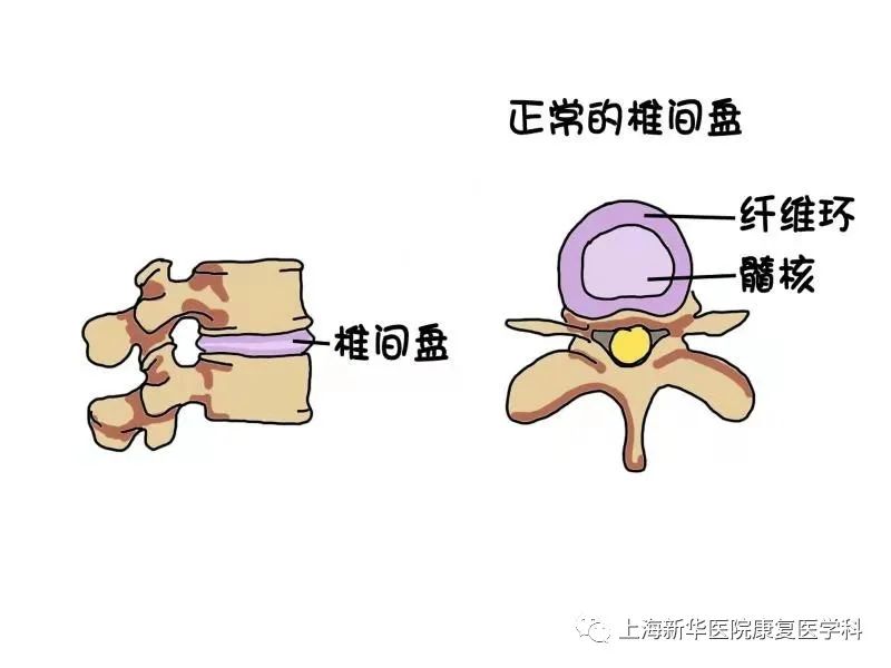 壓迫到坐骨神經者也會引起坐骨神經痛,突出的髓核還會刺激腰椎附近的