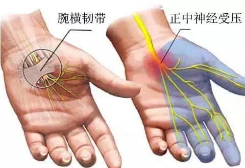 由于手腕关节长期进行反复和过度的活动从而导致腕部的肌肉,韧带及