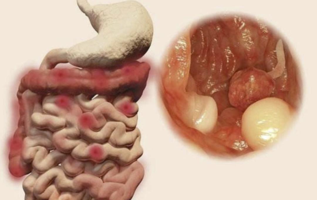 吃什麼能控制腸息肉