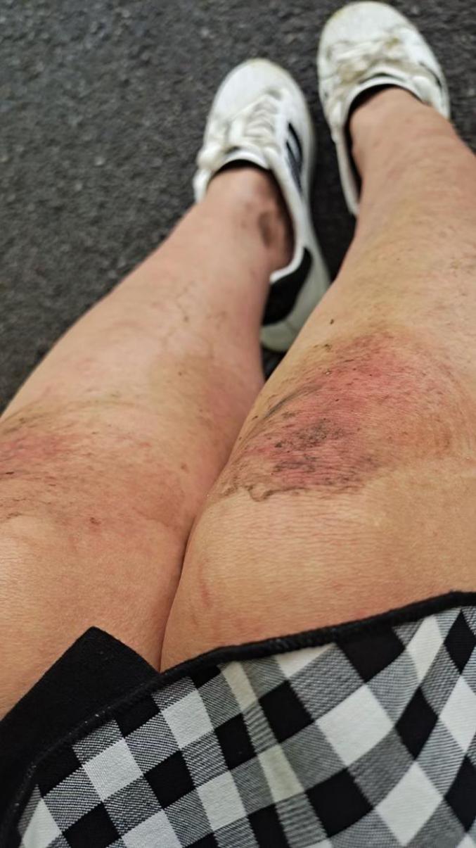 路边跪地抢救病人半小时49岁的她膝盖渗出了血