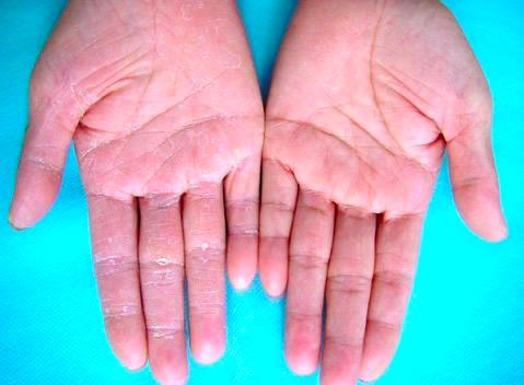 最常见的莫过于白癣了,中医叫白秃疮,因为它的特征是在头皮上最初出现