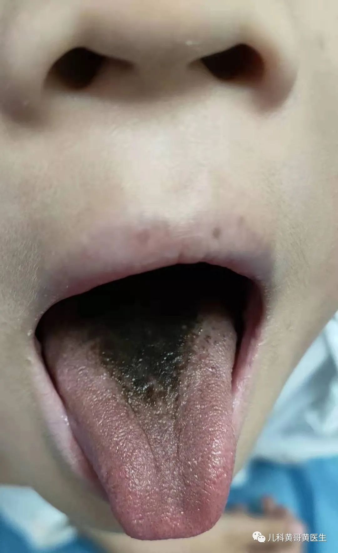 舌苔白腻是怎么回事如何调理（为什么舌苔变白了？和这5个原因有关，予以重视） | 说明书网