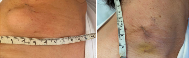 新技术血液科开展cart细胞治疗为复发难治性弥漫大b细胞淋巴瘤患者